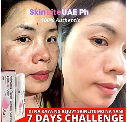 Skinlite Face Cream for Hyperpigmentation and Dark Spots Removal 25gm Skin Brightening and Whitening Cream for Uneven Skin Tone