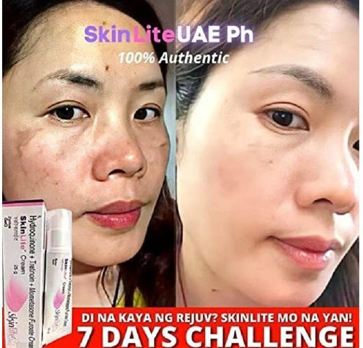 Skinlite Face Cream for Hyperpigmentation and Dark Spots Removal 25gm Skin Brightening and Whitening Cream for Uneven Skin Tone