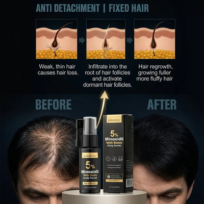 KORMESIC 5% Minoxidil with Biotin Scalp Serum – 30ml