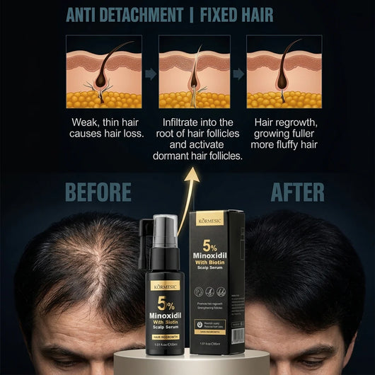 KORMESIC 5% Minoxidil with Biotin Scalp Serum – 30ml